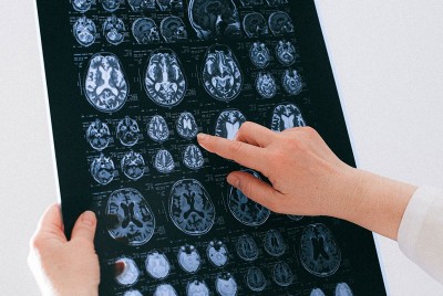 επιστήμονας κρατάει εγκεφαλική τομογραφία και υποδεικνύει τον κροταφικό λοβό