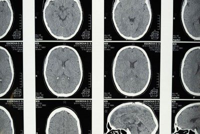 τομογραφία εγκεφάλου αναδεικνύει τις συνέπειες της COVID-19 που παραμένουν στον εγκεφαλικό ιστό για πολύ καιρό μετά την ανάρρωση