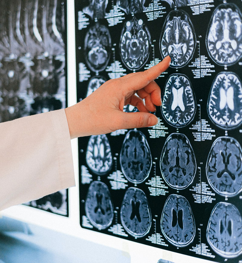 επιστήμονας δείχνει σε εγκεφαλική τομογραφία εγκεφάλου που επιτίθεται ο κορωνοϊός