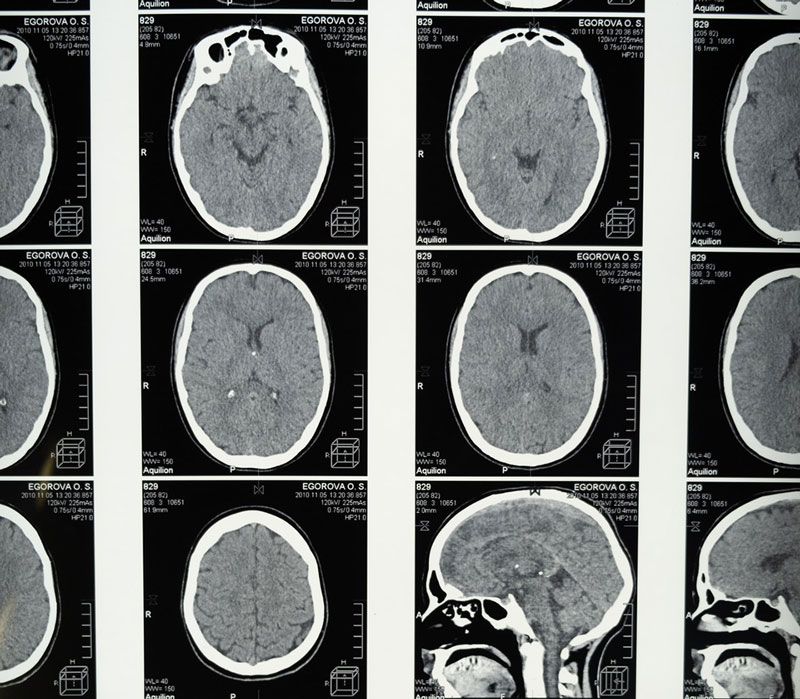 τομογραφία εγκεφάλου αναδεικνύει τις συνέπειες της COVID-19 που παραμένουν στον εγκεφαλικό ιστό για πολύ καιρό μετά την ανάρρωση