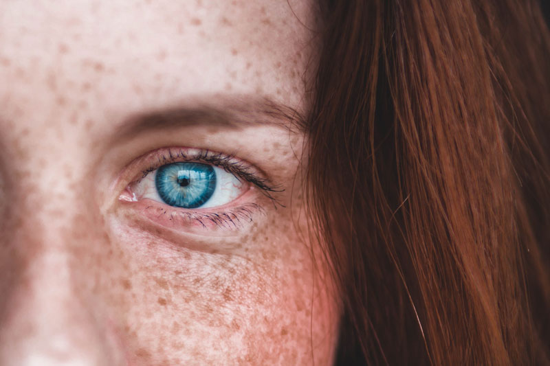 γυναίκα με φακίδες και μπλε μάτι