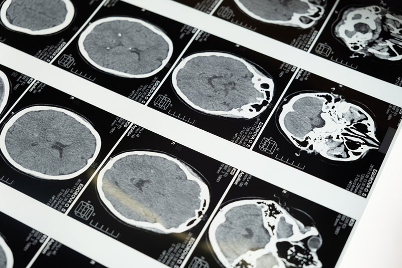 τομογραφίες εγκεφάλου που δείχνουν την εξέλιξη της νόσου του Αλτσχάιμερ