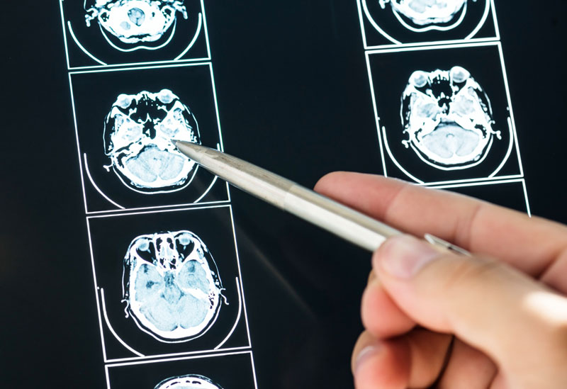 ερευνητές προκαλούν σε βάθος ηλεκτρική διέγερση του εγκεφάλου
