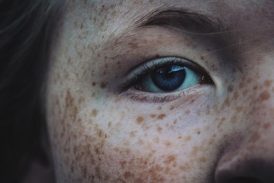 φωτογραφία γυναίκας με φακίδες που δείχνει το δεξί μάτι της