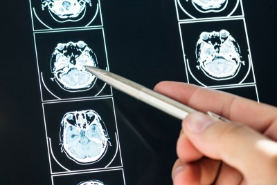 ερευνητές προκαλούν σε βάθος ηλεκτρική διέγερση του εγκεφάλου