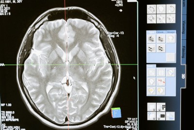 εξέταση εμφανίζει ότι το Prozac αλλάζει τη λιπιδική σύνθεση του εγκεφάλου