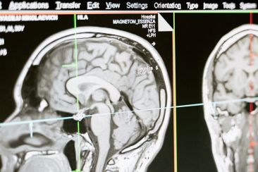 Ερευνητές ανέπτυξαν ένα πρωτοποριακό εγκεφαλικό εμφύτευμα που θεραπεύει τη σοβαρή κατάθλιψη