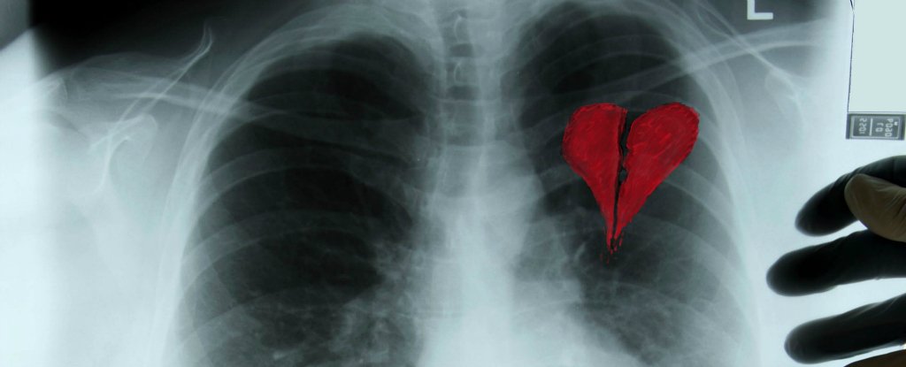 ραγισμένη καρδιά σε μια ακτινογραφία θώρακος